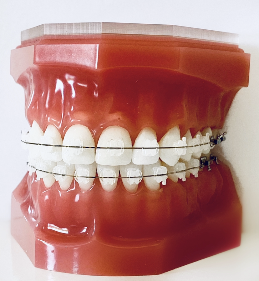 red braces for teeth